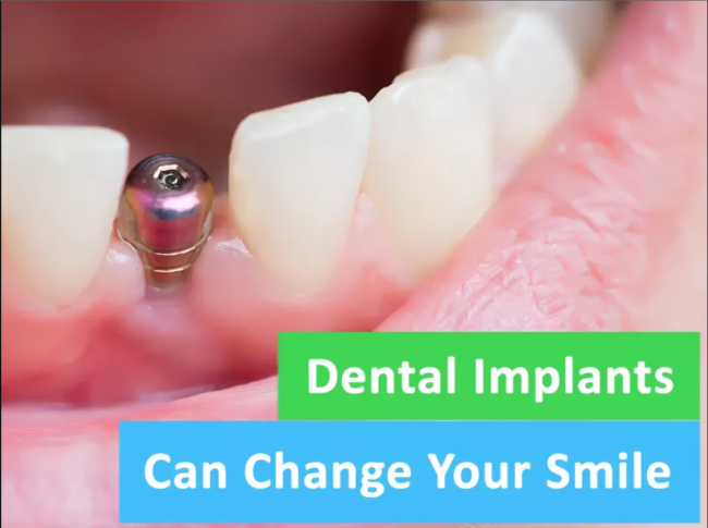 Transform Your Smile with the Best Dental Implants Transform Your Smile with the Best Dental Implants in Pune at Braces & Smiles