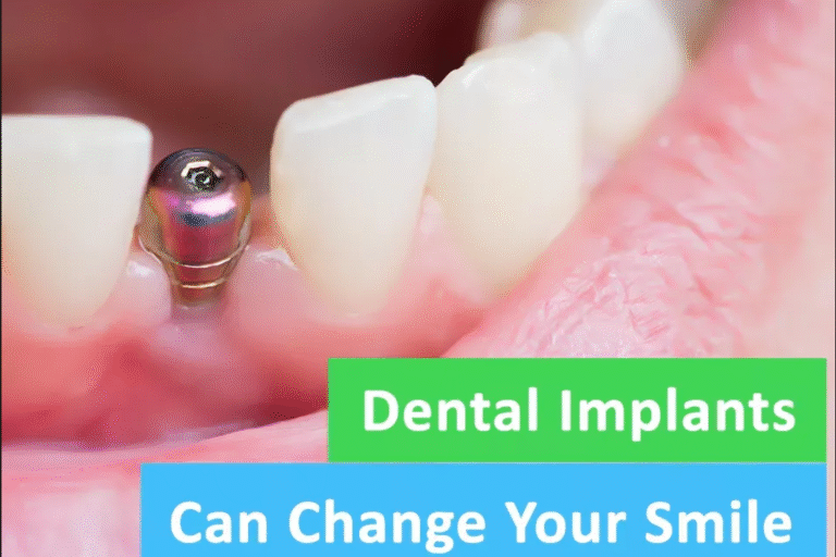 Transform Your Smile with the Best Dental Implants Transform Your Smile with the Best Dental Implants in Pune at Braces & Smiles