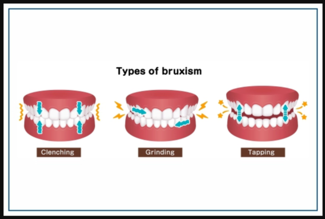Understanding Teeth Clenching and Effective Treatments in Pune Unveiling the Grind: Understanding Teeth Clenching and Effective Treatments in Pune with Braces & Smiles