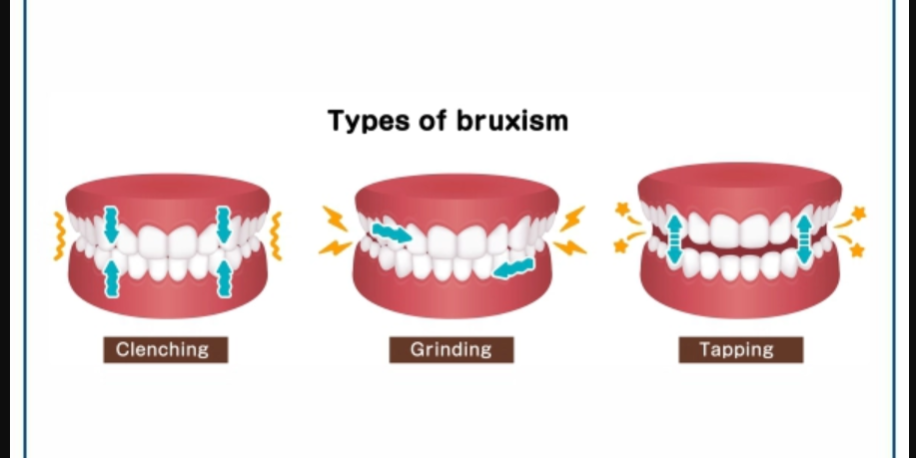 Unveiling the Grind: Understanding Teeth Clenching and Effective Treatments in Pune with Braces & Smiles