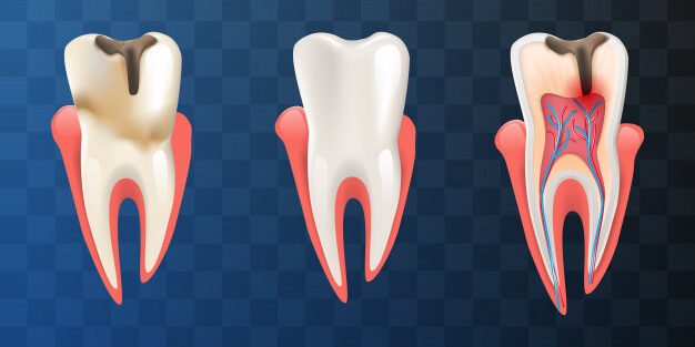 root-canal-treatment-in-pune Aftercare Matters: Guide for a Smooth Recovery from Root Canal Treatment in Pune