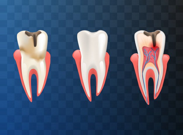 Aftercare Matters: Guide for a Smooth Recovery from Root Canal Treatment in Pune