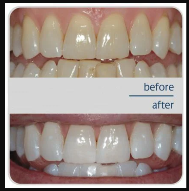 Sparkling Smiles: Your Guide to Teeth Whitening in Pune