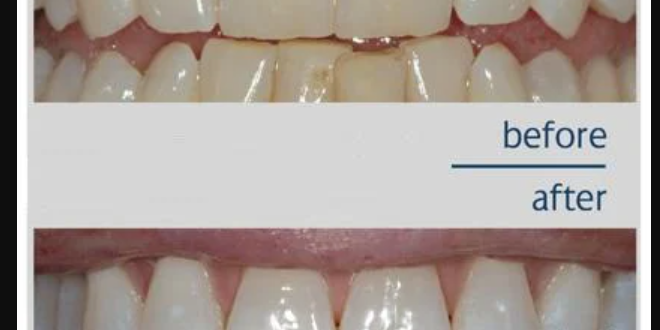 Teeth Whitening in Pune Sparkling Smiles: Your Guide to Teeth Whitening in Pune