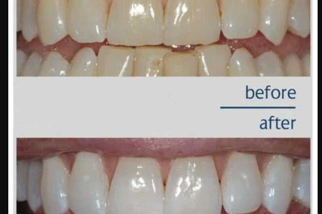 Sparkling Smiles: Your Guide to Teeth Whitening in Pune