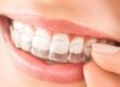Advantages of Enhancing Teeth Alignment Through Orthodontic Treatment in Pune