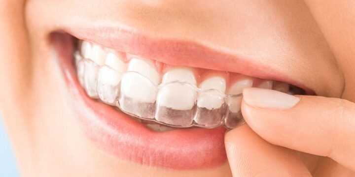 Modern-Ways-To-Align-Your-Teeth-Cover Advantages of Enhancing Teeth Alignment Through Orthodontic Treatment in Pune