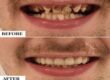 Braces for kids – What’s the right age?