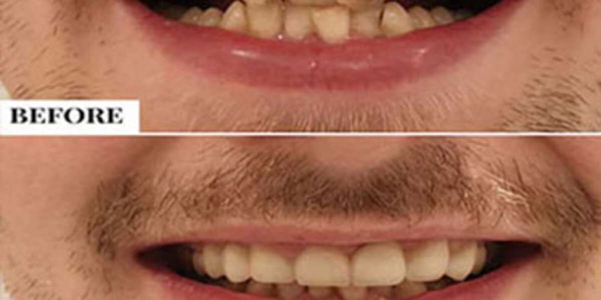 Braces for kids – What’s the right age?