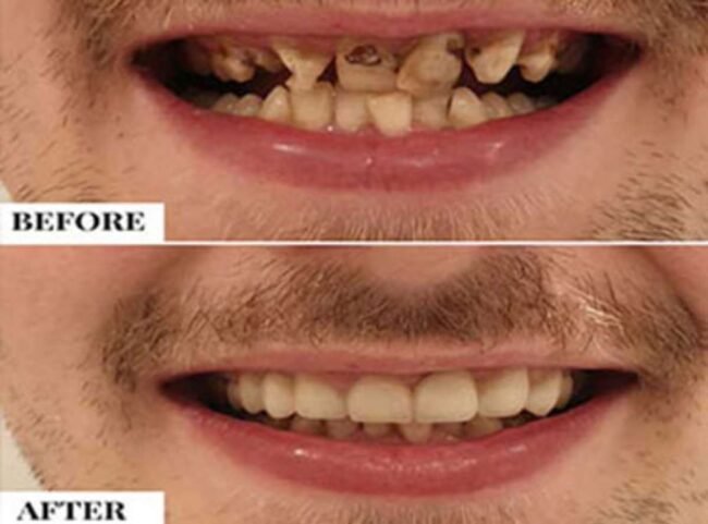 same-day-dentistrty Braces for kids – What’s the right age?