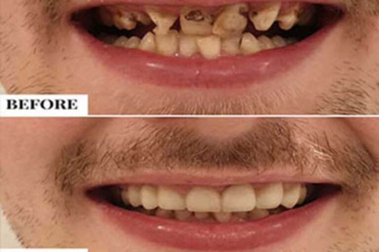 Braces for kids – What’s the right age?