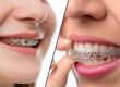 Invisalign vs. Traditional Braces: Which Will Make You Smile Brighter?