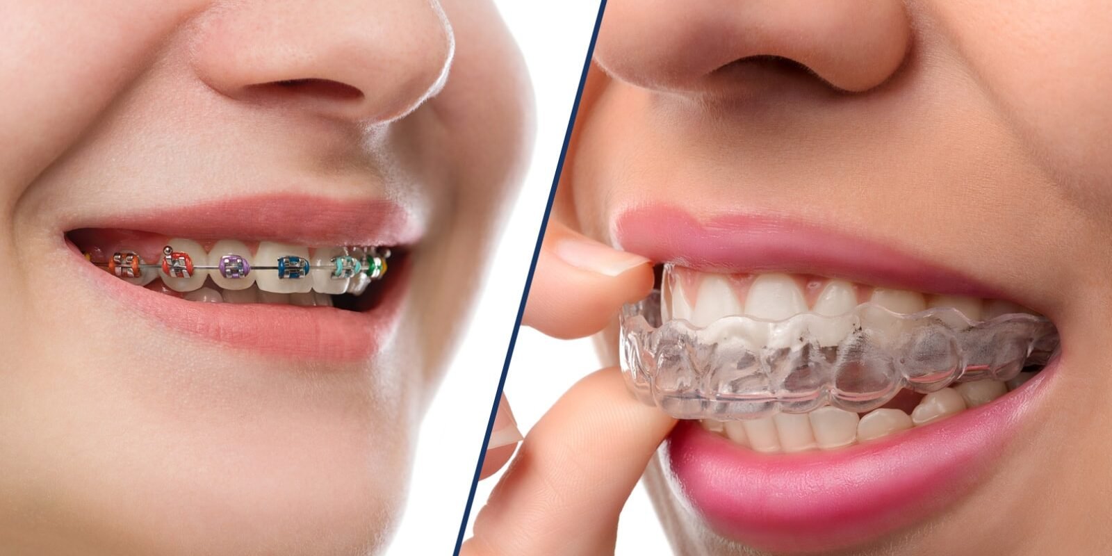 braces-vs-invisalign-hero Invisalign vs. Traditional Braces: Which Will Make You Smile Brighter?