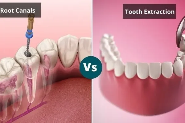 root-canal-tooth-extraction Root Canal Treatment vs. Tooth Extraction: Which is Better Option?