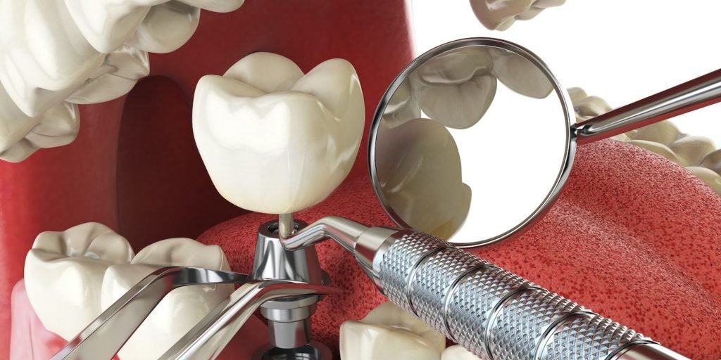 Preparing for Dental Implant Surgery: What You Need to Know