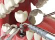 Preparing for Dental Implant Surgery: What You Need to Know
