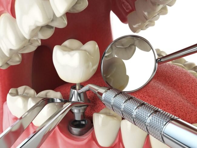 Your-Implant-Dentistry-Recovery-1024×768 Preparing for Dental Implant Surgery: What You Need to Know