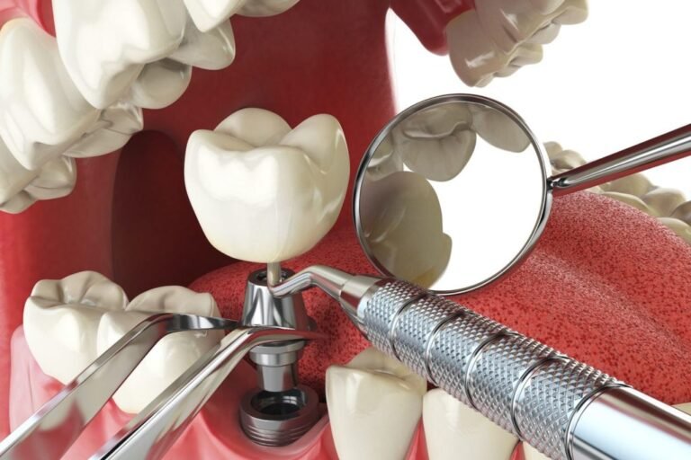 Your-Implant-Dentistry-Recovery-1024×768 Preparing for Dental Implant Surgery: What You Need to Know