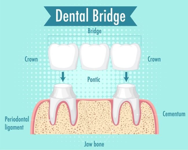 Dental Crown and Bridge