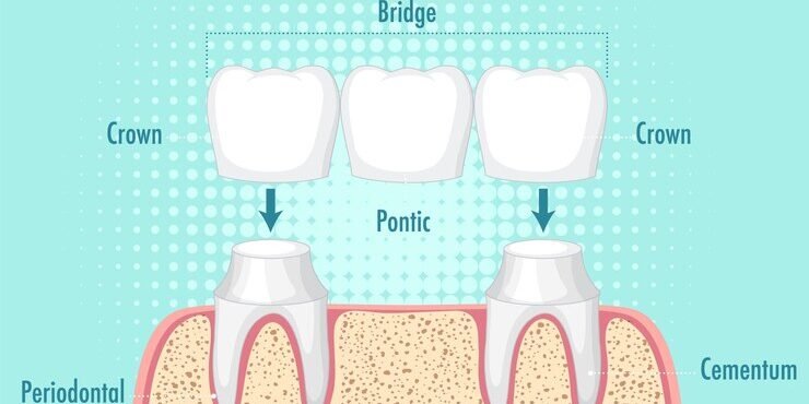 Dental Crown and Bridge Dental Crown and Bridge