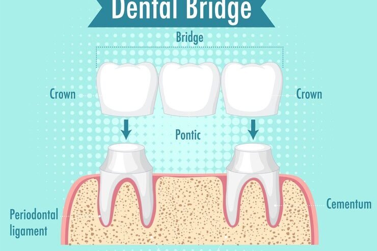 Dental Crown and Bridge Dental Crown and Bridge