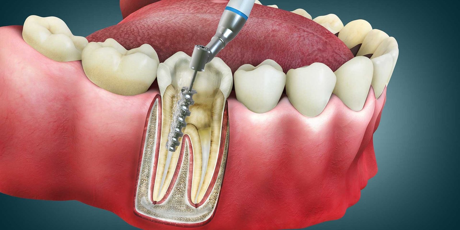 Root Canal Treatment