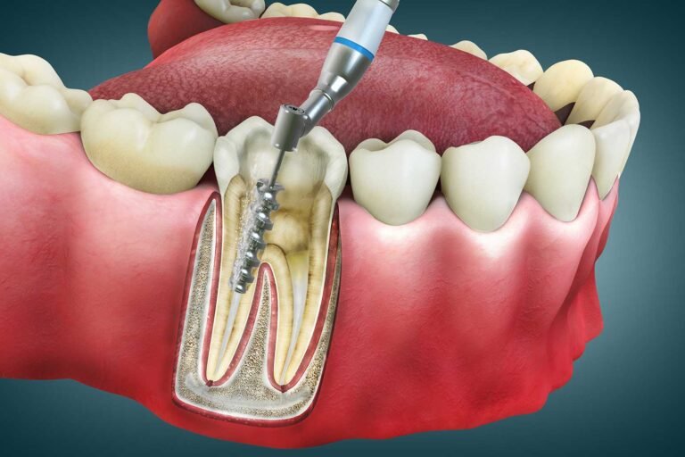 Root Canal Treatment Root Canal Treatment