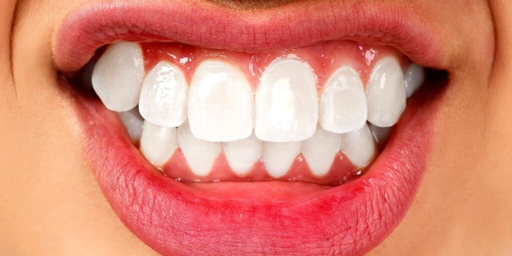 Teeth clenching Teeth clenching