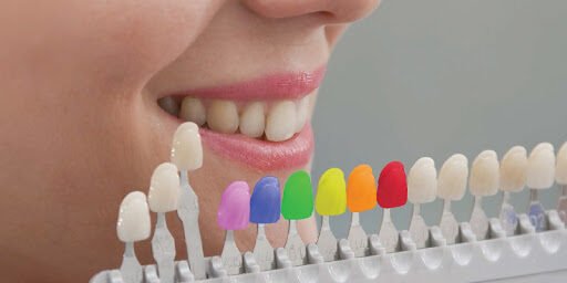 tooth-colored fillings