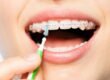 How to Care for Your Braces Tips from Top Orthodontists