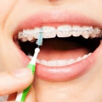 How to Care for Your Braces Tips from Top Orthodontists