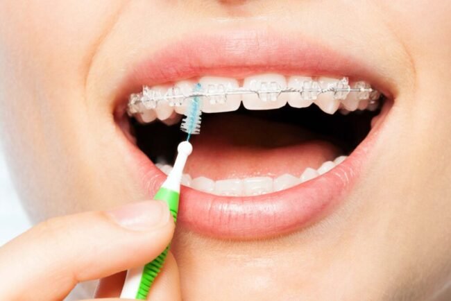 How to Care for Your Braces Tips from Top Orthodontists How to Care for Your Braces Tips from Top Orthodontists