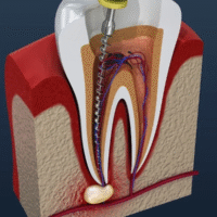 What to Expect During a Root Canal Treatment