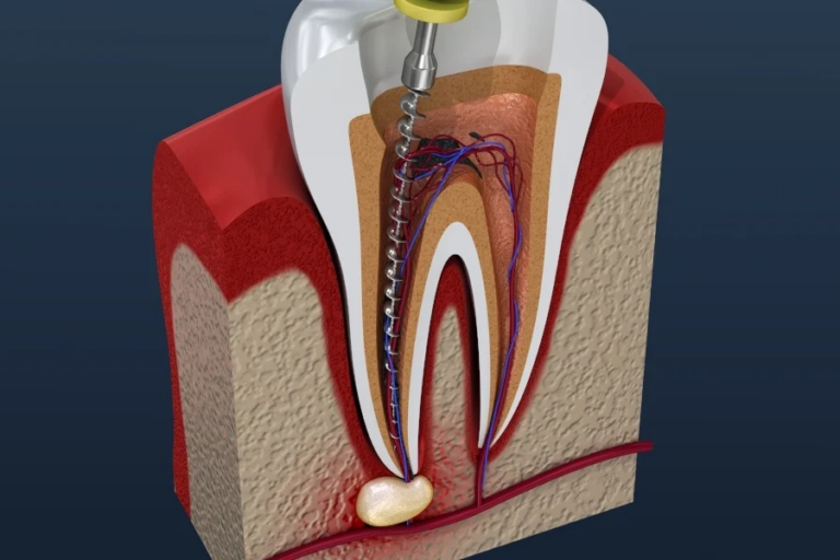 What to Expect During a Root Canal Treatment What to Expect During a Root Canal Treatment