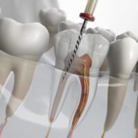 What Happens After a Painless Root Canal Treatment?