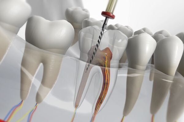 𝐏𝐚𝐢𝐧𝐥𝐞𝐬𝐬 𝐑𝐨𝐨𝐭 𝐂𝐚𝐧𝐚𝐥 𝐓𝐫𝐞𝐚𝐭𝐦𝐞𝐧𝐭 What Happens After a Painless Root Canal Treatment?