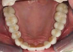 crown-and-bridges-after.