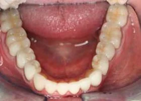 crown-and-bridges-after