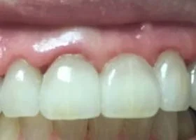 crown-and-bridges-after1