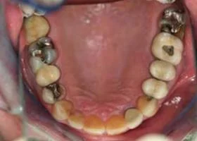 crown-and-bridges-before.