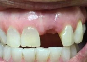 crown-and-bridges-before1