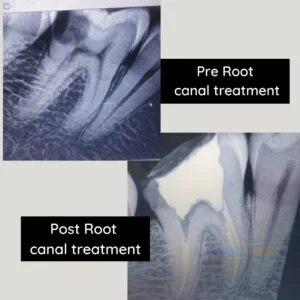 Find Affordable Root Canal Treatment in Pune Kalyani Nagar