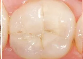 tooth-color-filling-after.