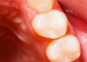 tooth-color-filling-after