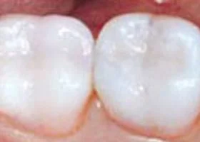tooth-color-filling-after1