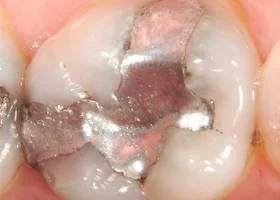 tooth-color-filling-before. tooth-color-filling-before.