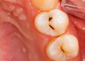 tooth-color-filling-before tooth-color-filling-before