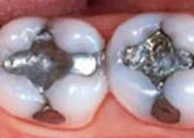 tooth-color-filling-before1 tooth-color-filling-before1