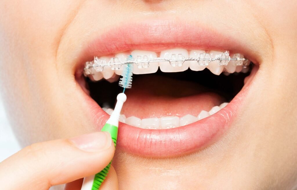 How to Care for Your Braces: Tips from Top Orthodontists