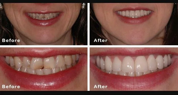The Benefits of Cosmetic Dentistry: Enhancing Your Smile and Confidence
